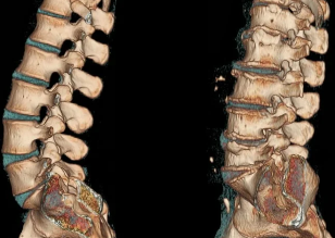 osteokondritis