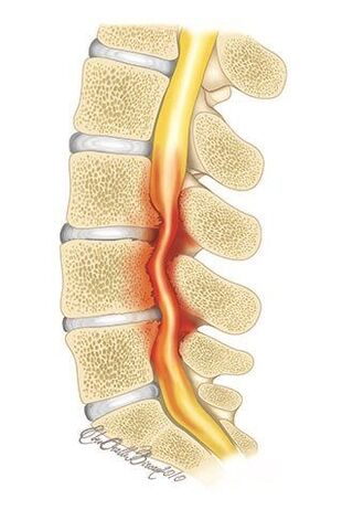Torasik omurganın osteokondrozu ile spinal kanalın sıkışması meydana gelir.