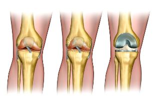derece osteoartrit