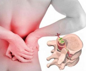 Bel ağrısı hastalığın başlangıcında osteochondrosis