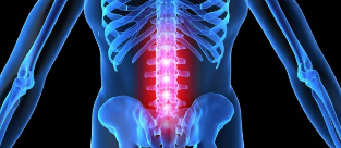 Deformasyon intervertebral disk
