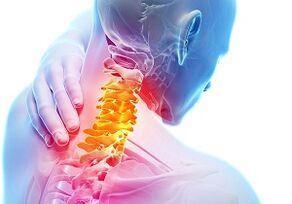 Servikal osteokondrozun ana belirtileri ve semptomları