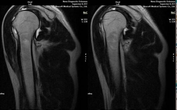 Omuz artrozunu teşhis etmek için röntgen