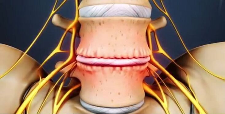 Osteokondroza bağlı omurga lezyonları